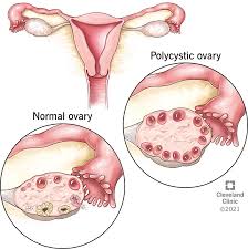 PCOD/PCOS